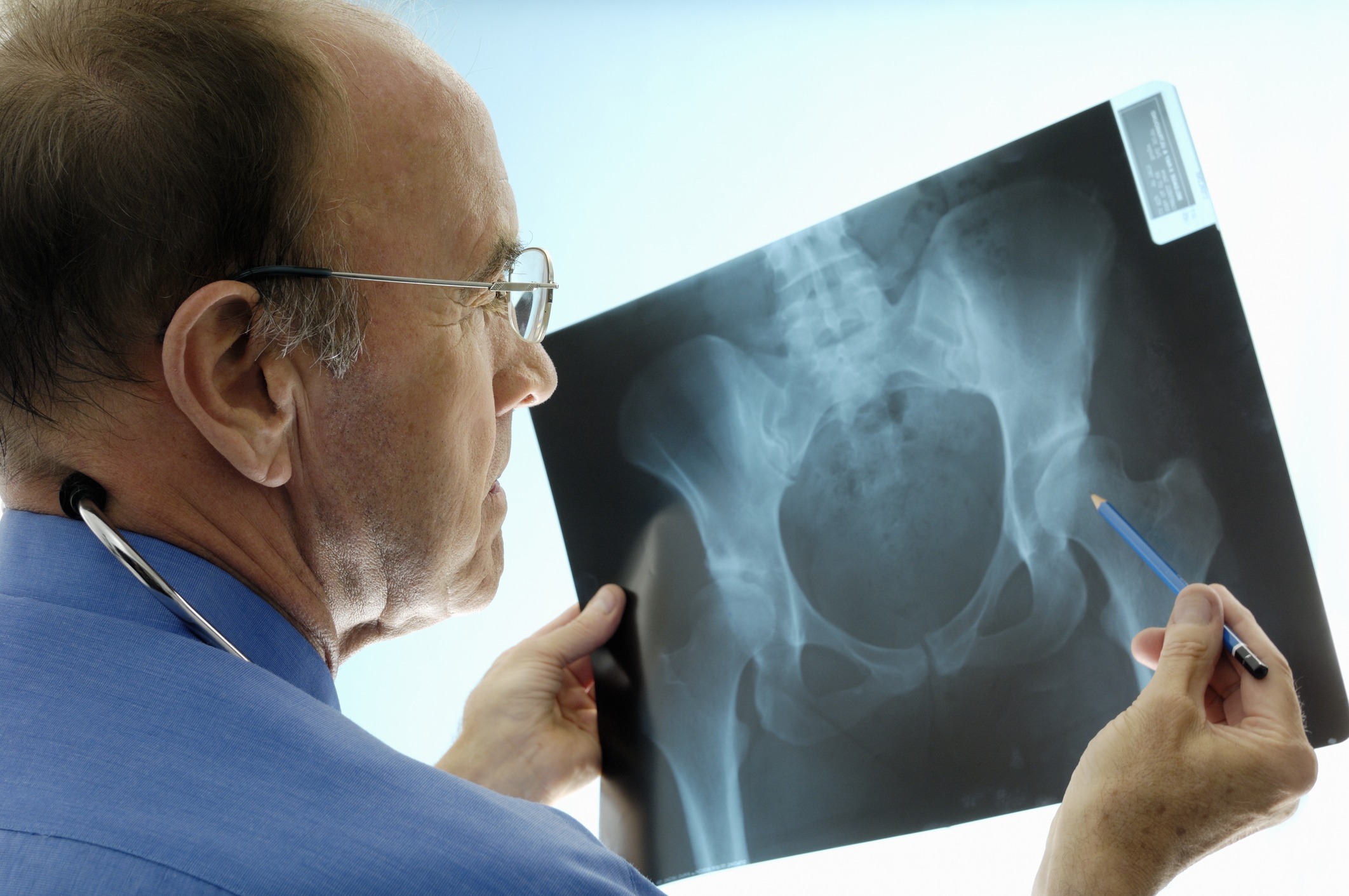 An experienced Caucasian orthopaedic surgeon (doctor) examining a pelvic x-ray displaying signs of osteoporosis - hip degeneration. Actual x-ray of a 42 year-old woman with a degenerative hip. The Orthopaedic surgeon is using a pencil to point at the hip where the problem is. This patient is a candidate (real) for hip replacement. The dominant colour is blue.